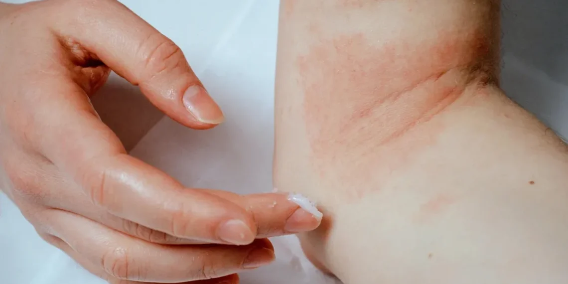 Piel seca o eccema: cuáles son las diferencias y cuándo consultar a un especialista