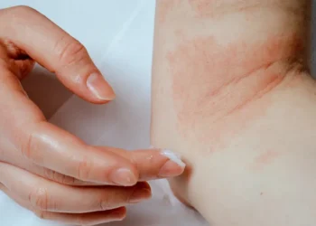 Piel seca o eccema: cuáles son las diferencias y cuándo consultar a un especialista
